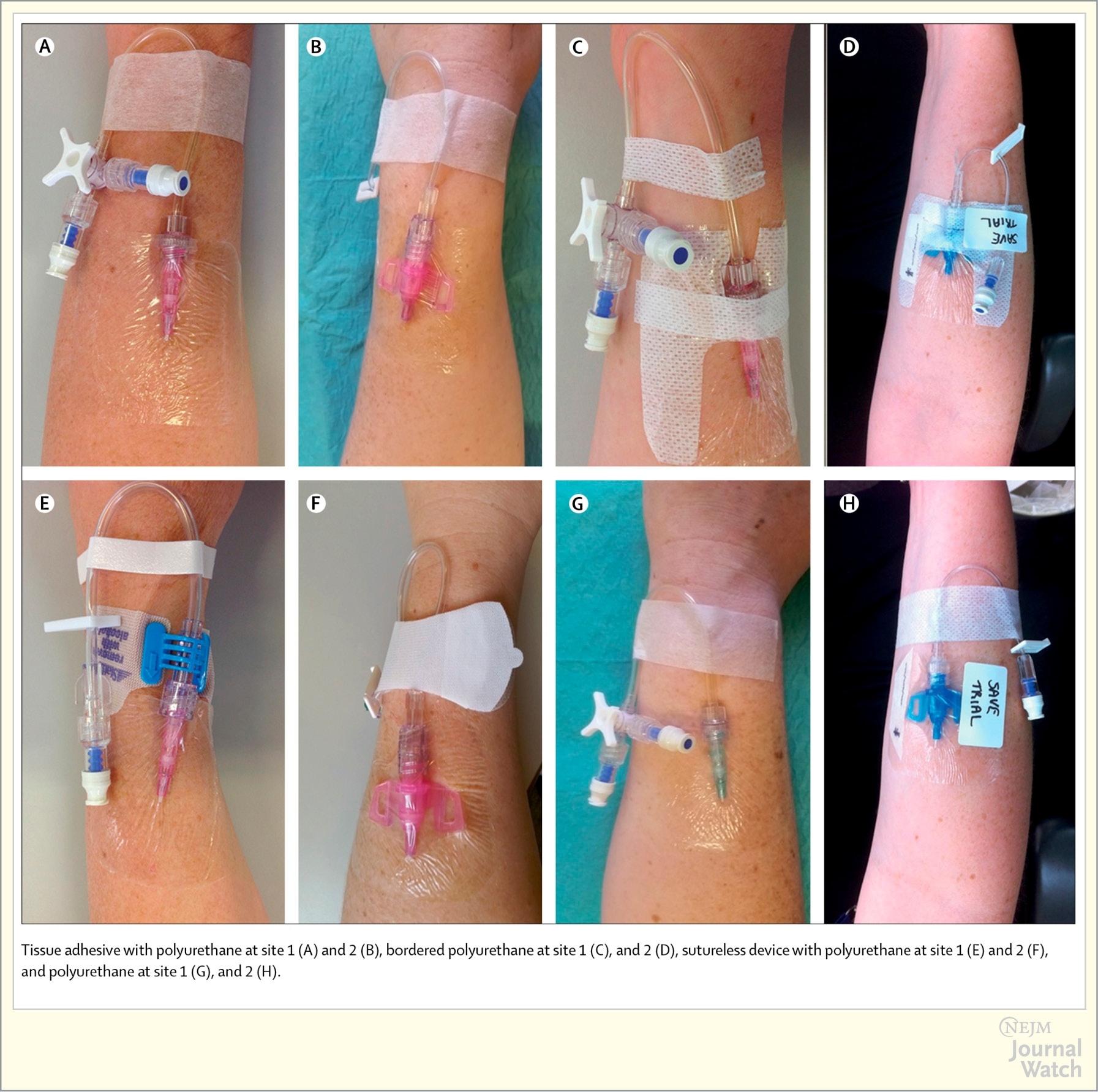 Best Method for Securing and Dressing Peripheral Intravenous Catheters | NEJM Clinician Best Method for Securing and Dressing Peripheral Intravenous Catheters | NEJM Clinician
